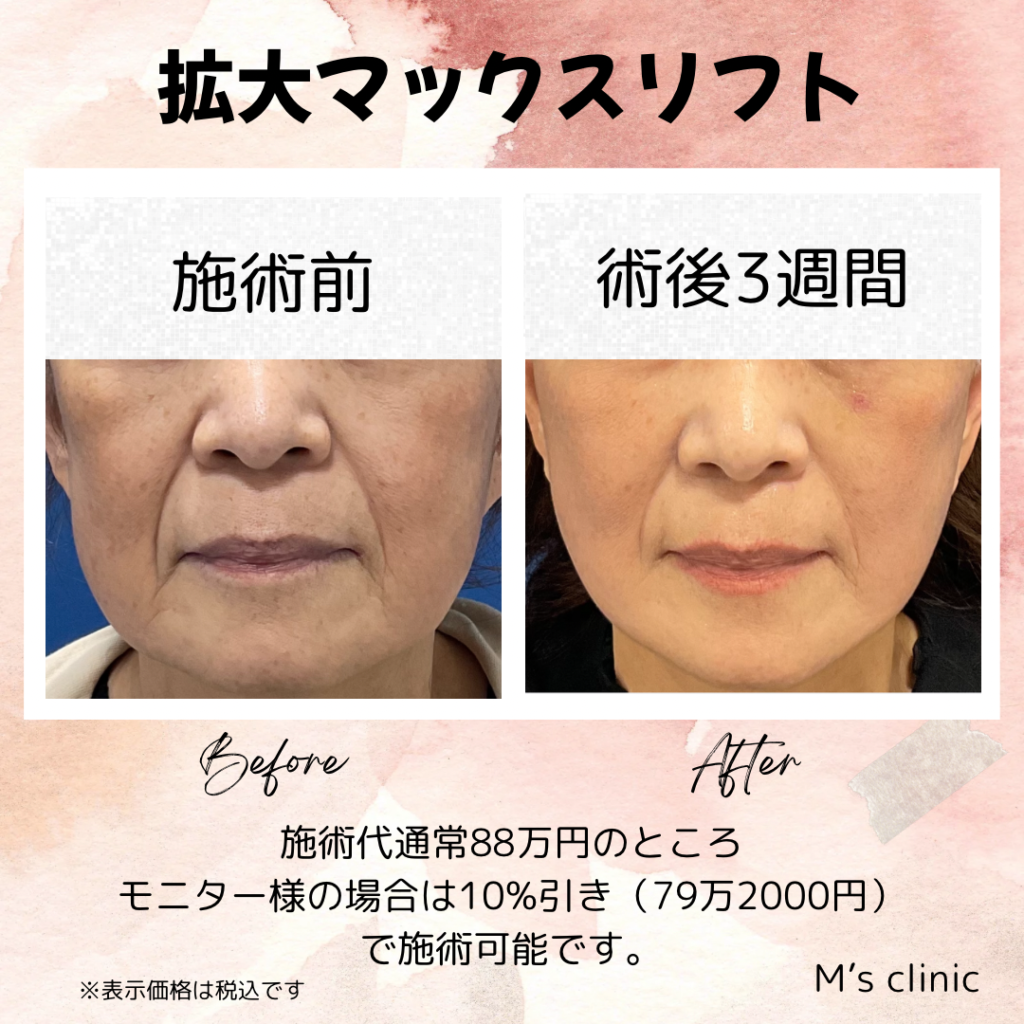 術後3週目の経過です。